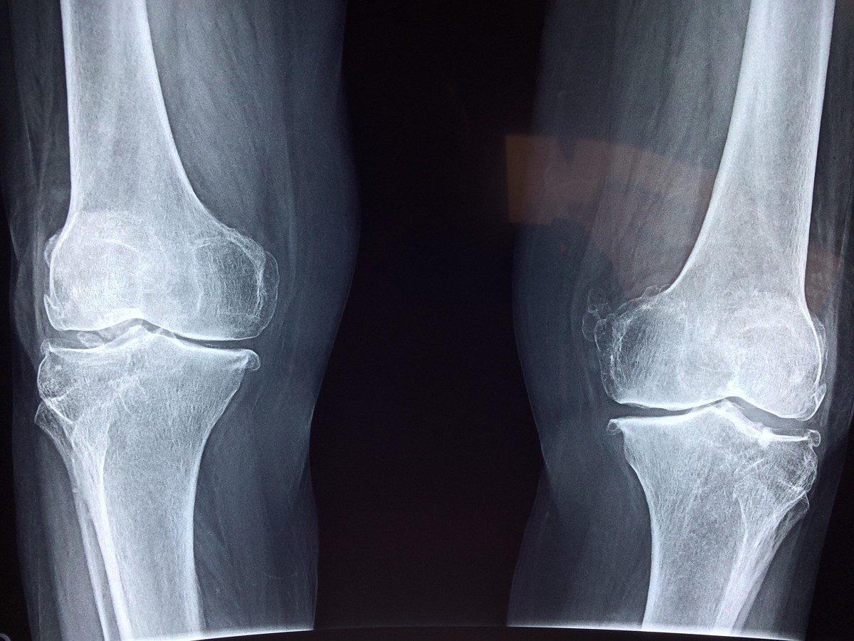 Bone injury and fracture